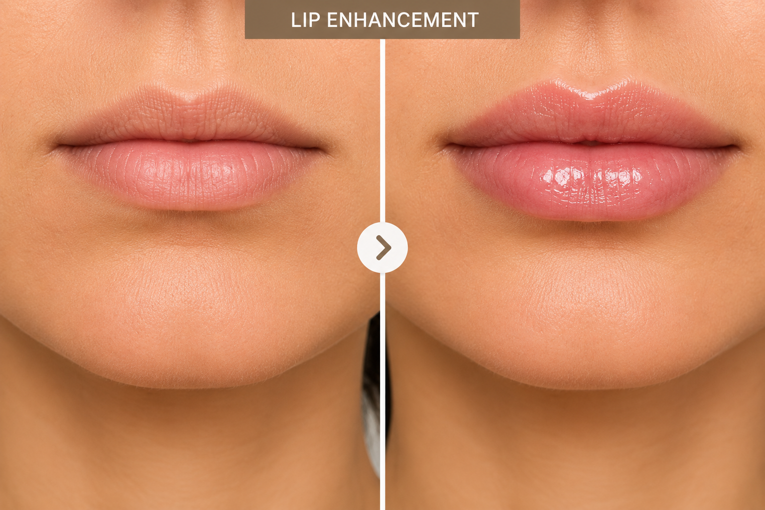 Lip filler